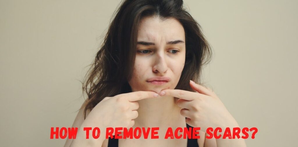 Tips to remove acne Scars